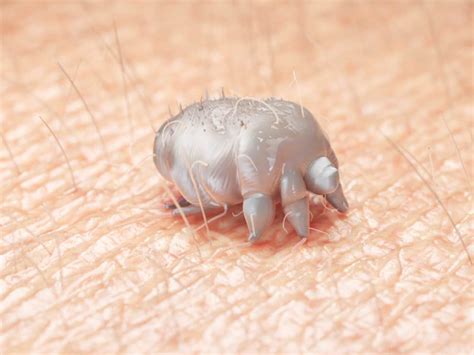 Mainaman na Tips: Alamin Paano Makaiiwas sa Scabies.